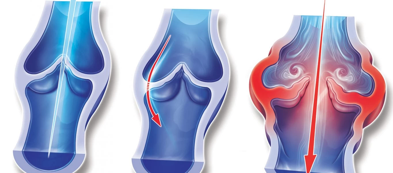 Ποια είναι τα συμπτώματα της φλεβίτιδας που χρειάζονται προσοχή